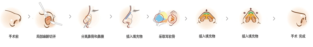 韩国鼻部整形的基本流程