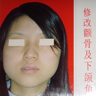 修改颧骨及下颌角