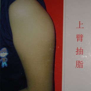 上臂抽脂